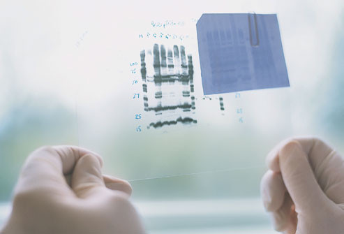 Gen ung thư vú: Các gen phổ biến nhất liên quan đến bệnh ung thư vú được gọi là BRCA1 và BRCA2. Phụ nữ có đột biến ở các gen này có đến 80% nguy cơ bị ung thư vú. Ngoài ra còn một có gen khác có thể liên quan đến nguy cơ ung thư vú.