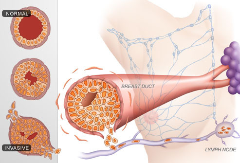 Các giai đoạn ung thư vú: Sau khi chẩn đoán ung thư vú, bước tiếp theo là xác định độ lớn và phạm vi lan rộng của khối u. Các bác sĩ xác định các giai đoạn từ 0 đến 4 để mô tả khối u định hình ở ngực, đã xâm chiếm các hạch bạch huyết gần đó, hay đã di căn đến các cơ quan khác, như phổi. Xác định giai đoạn và loại ung thư vú sẽ giúp đội ngũ chăm sóc y tế xây dựng lộ trình điều trị thích hợp.