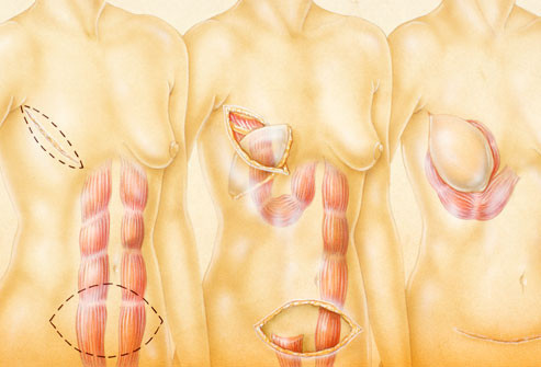 Tái tạo ngực: Nhiều phụ nữ bị cắt bỏ ngực lựa chọn giải pháp tái tạo bầu ngực sau khi điều trị. Phương pháp này sẽ thay thế da, nhũ hoa và các mô vú bị mất. Bác sĩ sẽ tái tạo bằng cách cấy ghép ngực hoặc ghép mô từ một nơi khác trong cơ thể của bạn, chẳng hạn như bụng. Một số phụ nữ quyết định tái tạo ngực ngay trong khi phẫu thuật cắt bỏ ngực. Nếu để sau khi phẫu thuật, họ có thể phải chờ vài tháng đến cả năm sau.