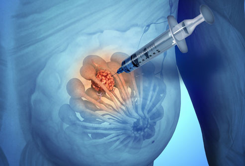 Sinh thiết: Cách duy nhất để xác định ung thư là làm sinh thiết. Nghĩa là các bác sĩ sẽ lấy một mẫu mô của bạn (có thể chỉ cần lấy qua một kim tiêm nhỏ) để kiểm tra kỹ hơn trong phòng thí nghiệm. Phẫu thuật đôi khi được chỉ định để lấy ra một phần hoặc toàn bộ khối u để xét nghiệm. Kết quả sẽ cho biết khối u có ung thư hay không và nếu đúng thì là loại gì để lựa chọn phương pháp điều trị phù hợp.