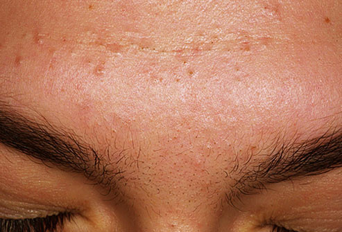 Mụn trứng cá do cơ học: là loại mụn gây ra do nhiệt, ma sát, và áp lực đối với da, thường là kết quả của việc mặc các đồ thể thao như mũ bảo hiểm hoặc mũ bóng chày. Đôi khi nó được gọi là "mụn trứng cá thể thao" - loại mụn phổ biến trong giới vận động viên. Biện pháp phòng ngừa bao gồm mặc/đội tấm lót dưới đồ thể thao và tắm ngay sau khi vận động.