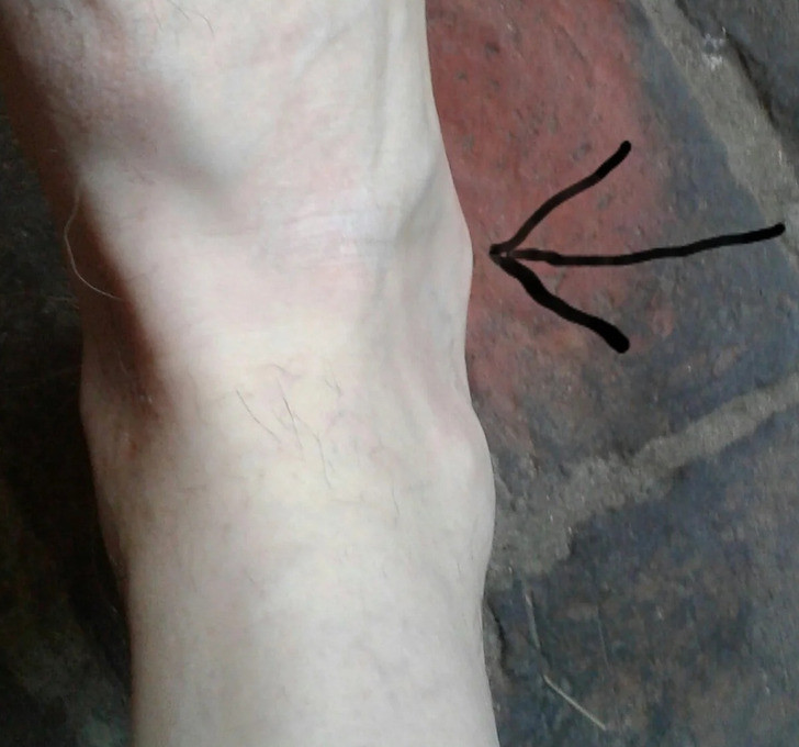 “Tôi có mắt cá chân thứ hai. Bác sĩ riêng của tôi nói rằng đây là lần đầu tiên ông nhìn thấy sau nhiều năm làm việc trong ngành y".