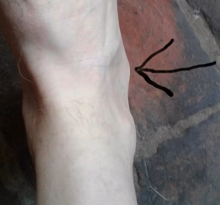 “Tôi có mắt cá chân thứ hai. Bác sĩ riêng của tôi nói rằng đây là lần đầu tiên ông nhìn thấy sau nhiều năm làm việc trong ngành y".