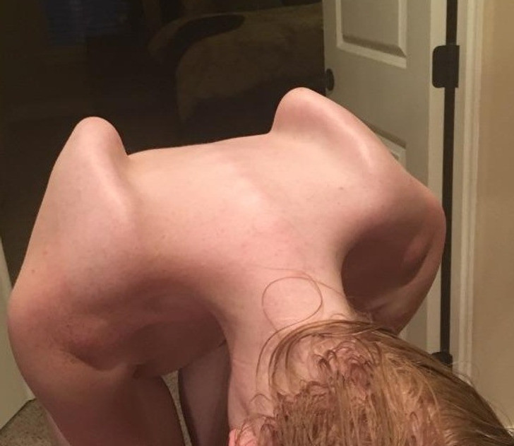 "Tôi bị khớp đôi ở cả hai bả vai. Chỉ cần cúi xuống, vai tôi trông giống như một chiếc ghế".