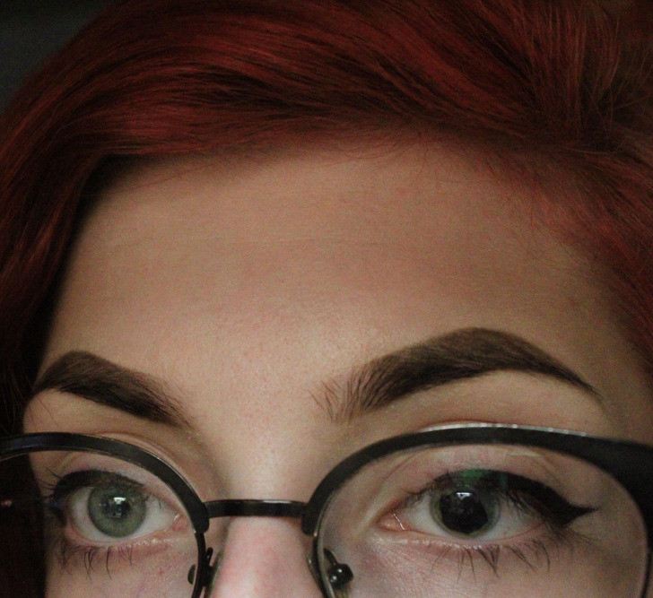 "Mắt trái của tôi không có đồng tử ngay từ khi sinh ra"