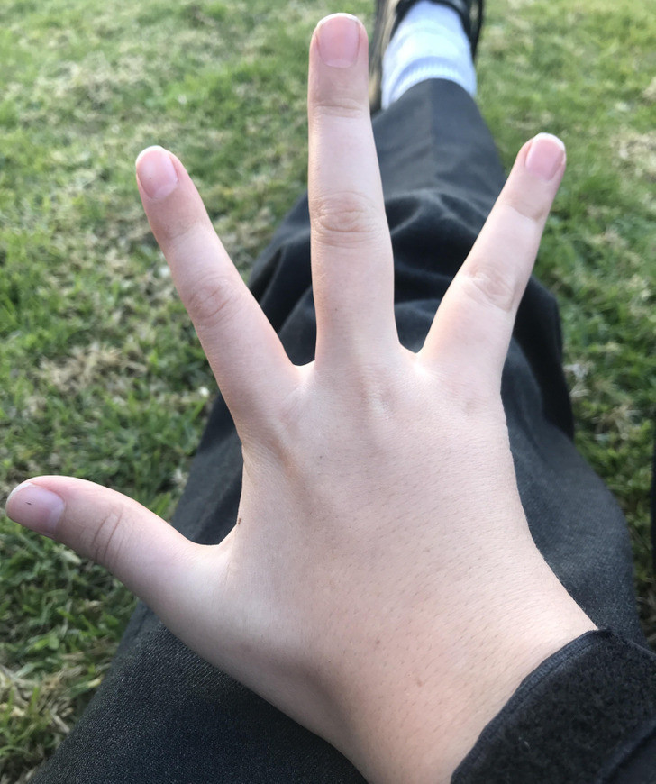 "Tôi là chàng trai có 4 ngón tay trên bàn tay phải!"