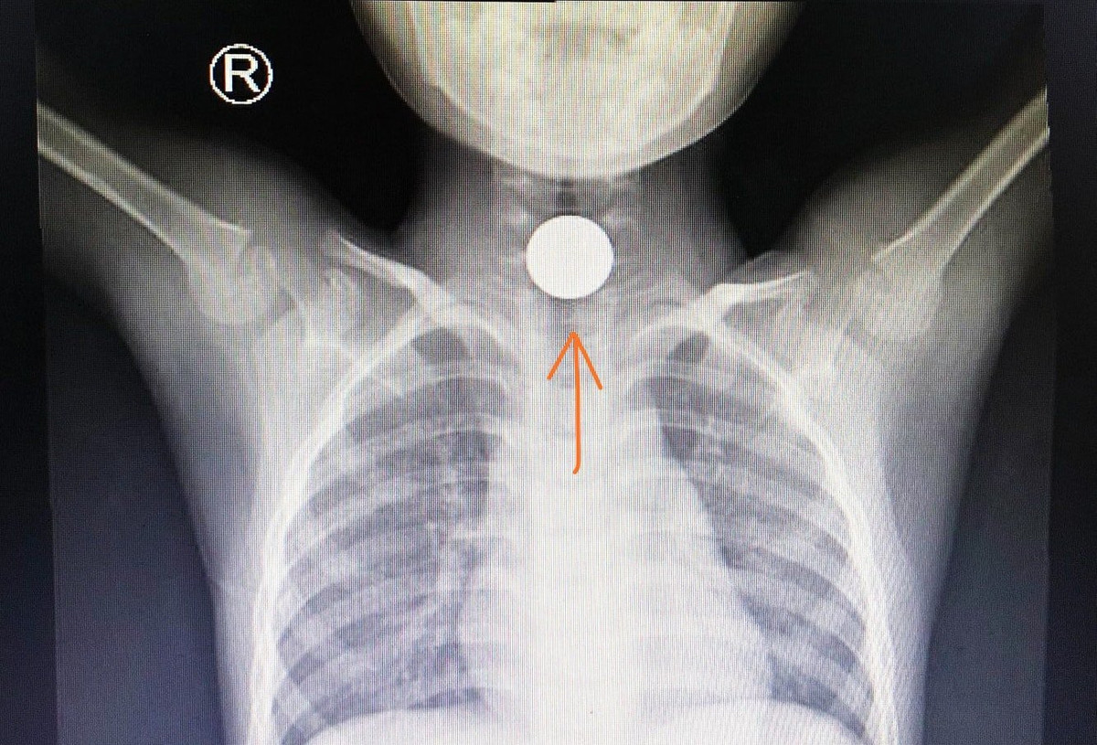 Nhieu tre nhap vien ngay Tet do tai nan nghiem trong-Hinh-2