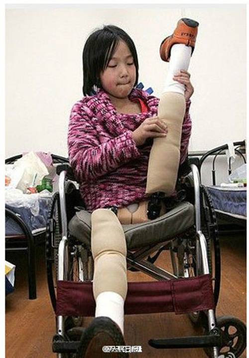 Năm 2005, nhờ có sự quan tâm của truyền thông, Qian Hongyan đã đến Bắc Kinh để được lắp một đôi chân giả miễn phí tại Trung tâm nghiên cứu phục hồi chức năng. Tuy nhiên do gia cảnh khó khăn, cô bé đã phải bỏ học khi mới 11 tuổi.