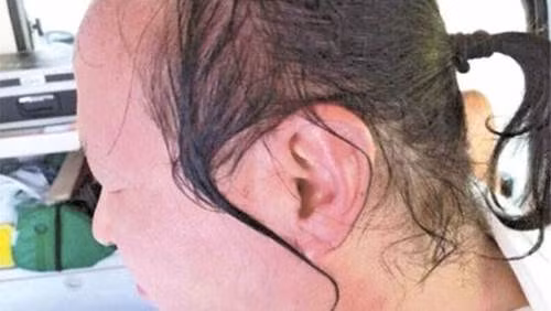 Giáo sư bị bỏng cấp độ 2 ở mặt và cổ khi bị nữ sinh hắt nước nóng.