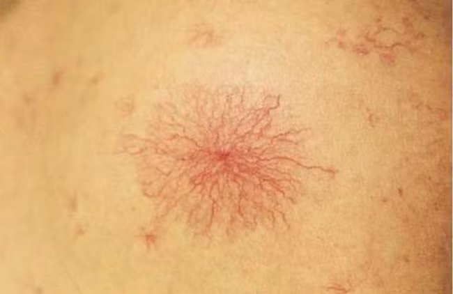 Tiền ung thư gan xuất hiện dấu hiệu này cần đi gặp bác sĩ ngay - Hình 3 Tien ung thu gan xuat hien dau hieu nay can di gap bac si ngay-Hinh-3