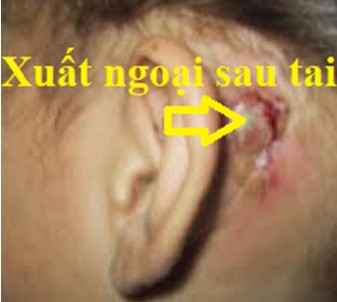 Tai co mui hoi thoi - trieu chung cua nhieu benh ly nguy hiem-Hinh-3