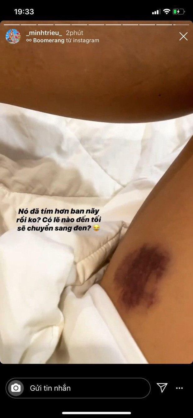 Kỳ Duyên và Minh Triệu than thở vì vết bầm tím trên đùi - Hình 2 Ky Duyen va Minh Trieu than tho vi vet bam tim tren dui-Hinh-2