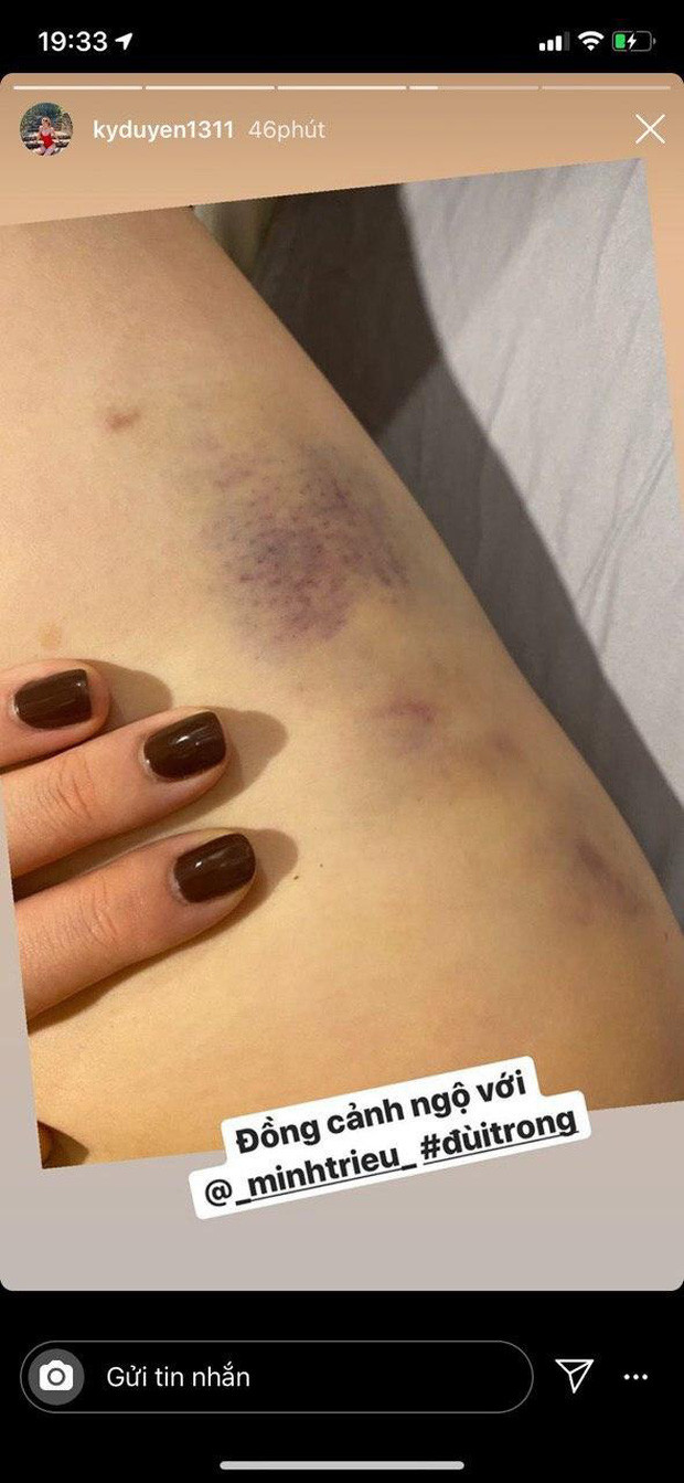 Kỳ Duyên và Minh Triệu than thở vì vết bầm tím trên đùi - Hình 3 Ky Duyen va Minh Trieu than tho vi vet bam tim tren dui-Hinh-3