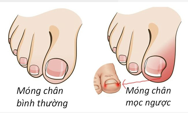 Lỗi sai khi cắt móng tay dễ gây viêm nhiễm đau đớn Loi sai khi cat mong tay de gay viem nhiem dau don