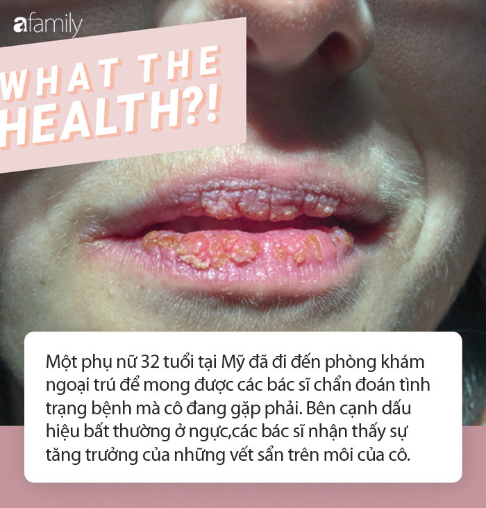 Khi môi xuất hiện điều bất thường này, hãy cẩn trọng Khi moi xuat hien dieu bat thuong nay, hay can trong