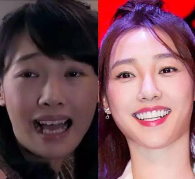 Những hàm răng khấp khểnh kém duyên của sao Hoa ngữ - Hình 9 Nhung ham rang khap khenh kem duyen cua sao Hoa ngu-Hinh-9