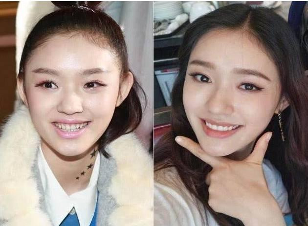 Những hàm răng khấp khểnh kém duyên của sao Hoa ngữ - Hình 5 Nhung ham rang khap khenh kem duyen cua sao Hoa ngu-Hinh-5