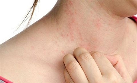 Ăn tôm kiểu này rước bệnh vào người mà không hay biết - Hình 2 An tom kieu nay ruoc benh vao nguoi ma khong hay biet-Hinh-2