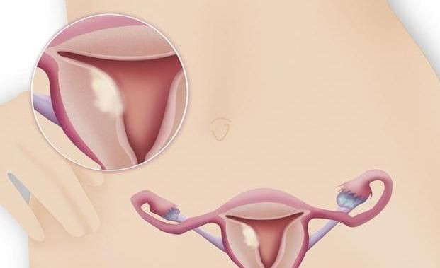 3 thoi quen lam tang nguy co mac ung thu co tu cung-Hinh-2