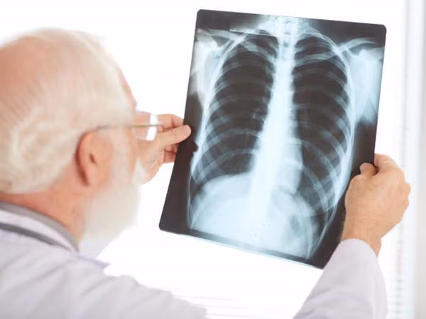 10 bien chung nguy hiem cua benh COVID-19-Hinh-2