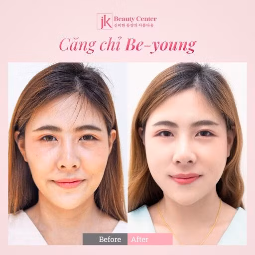 Cong nghe cang chi Be-Young duoc phu nu Viet san don