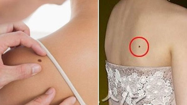 Vị trí nốt ruồi phát tài phát lộc, cả đời sẽ hưởng no phú quý Vi tri not ruoi phat tai phat loc, ca doi se huong no phu quy