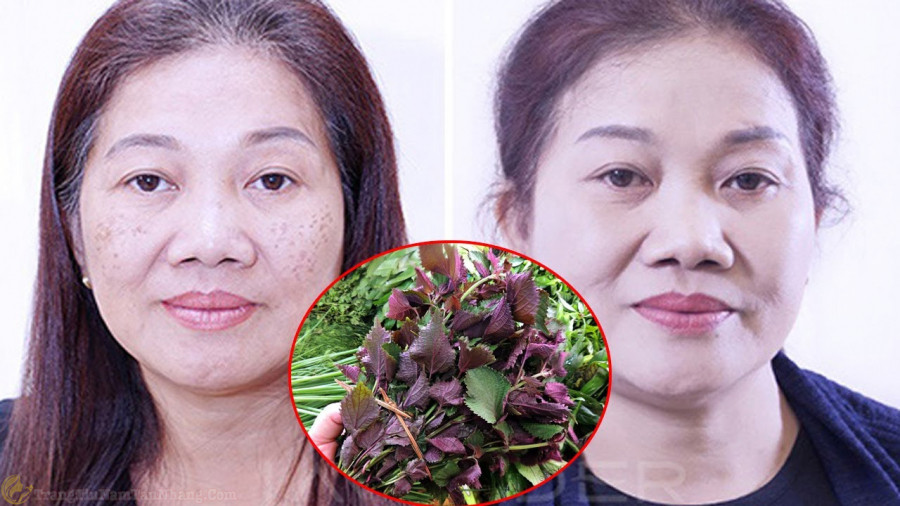 Cách trị nám và tàn nhang chỉ với một bó lá tía tô - Hình 3 Cach tri nam va tan nhang chi voi mot bo la tia to-Hinh-3