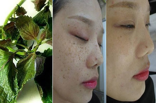 Cách trị nám và tàn nhang chỉ với một bó lá tía tô Cach tri nam va tan nhang chi voi mot bo la tia to