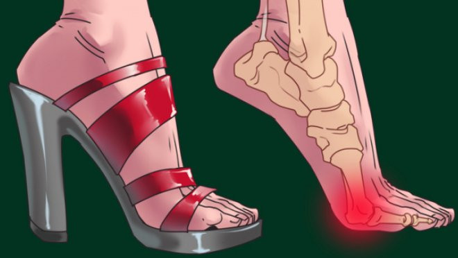 Chị em đi giày cao gót để đẹp nhưng khiến bộ phận này đau đớn Chi em di giay cao got de dep nhung khien bo phan nay dau don