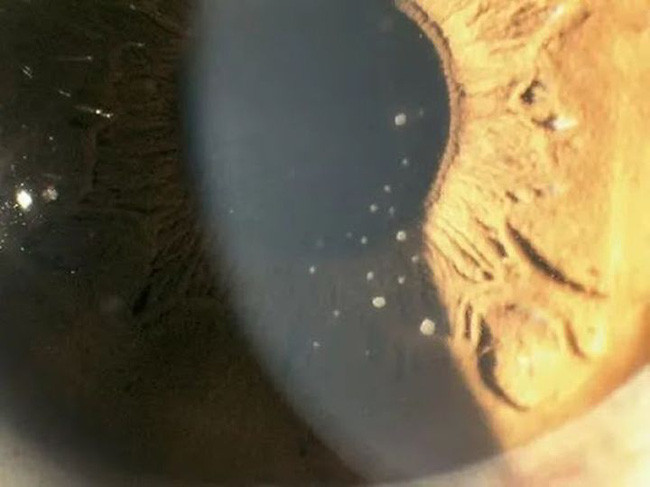 Thức khuya và làm thêm cả tuần người phụ nữ suýt bị mù Thuc khuya va lam them ca tuan nguoi phu nu suyt bi mu