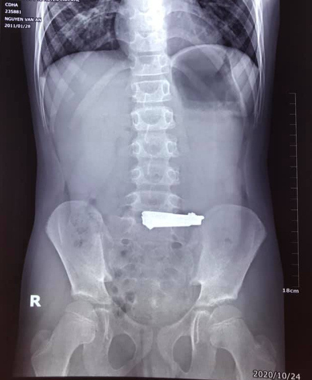 Be gai 9 tuoi nuot cai bam mong tay phai cap cuu o Phu Tho