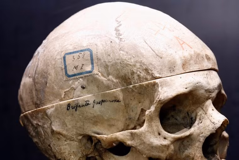 Phần lớn sọ đã bị chặt ra để lấy bộ óc phục vụ cho nghiên cứu y học.