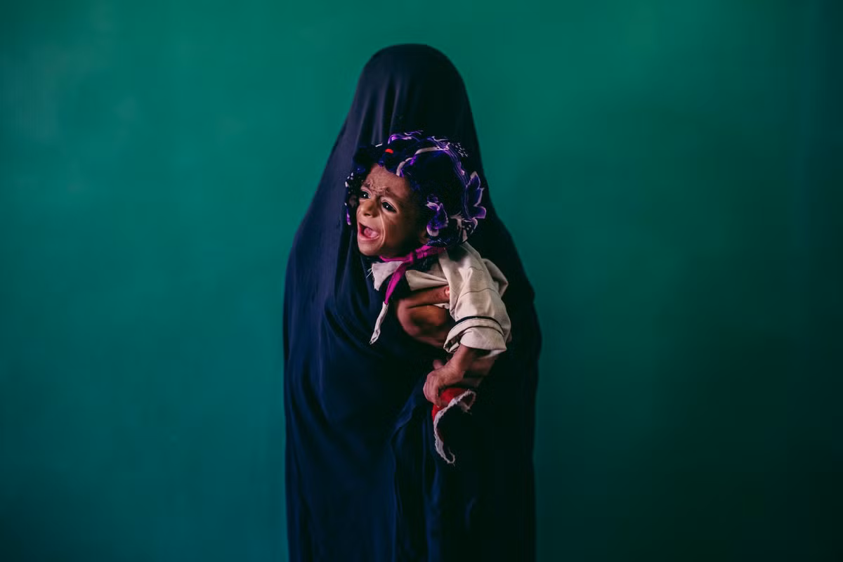 Bé Samiullah 8 tháng tuổi - bị suy dinh dưỡng - trong vòng tay mẹ Islam Bibi, 15 tuổi, tại một bệnh viện ở Lashgar Gar, tỉnh Helmand Province, vào tháng 9/2013.