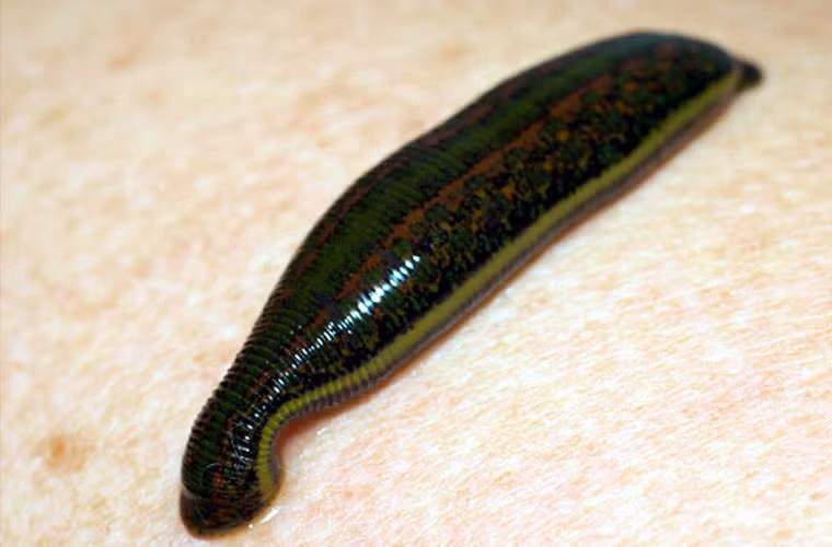 Có khi con đỉa no máu thập thò ở lỗ mũi. Theo các bác sĩ, lúc này không nên cố lôi nó ra vì đỉa bám rất chắc, sẽ càng gây chảy máu nặng hơn. Cũng đừng nhỏ thuốc sát khuẩn mạnh như nước vôi, nước điếu vào mũi như các mẹo dân gian. Nên đến bác sĩ để được xử lý.