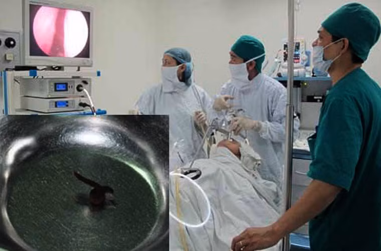 Anh Nguyễn Ngọc D. (tập thể Thanh Xuân, Hà Nội) sau khi đi du lịch Suối Hai về khoảng 2 tháng mới được bác sĩ phát hiện và gắp ra con đỉa sống trong mũi. (Ảnh minh họa)