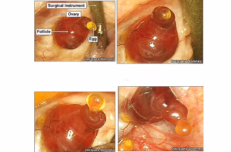 Quả trứng được tạo ra từ nang – những túi chứa đầy chất lỏng. Nang này lồi lên một cục đỏ sẫm rồi quả trứng chui ra, bị bao phủ bởi một lớp chất dịch sánh để bảo vệ. Theo bác sĩ Donnez, toàn bộ quá trình diễn ra trong vòng 15 phút.