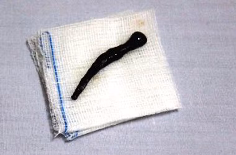 Chị Trịnh Thị M. ở Bạc Liêu sau một lần ngã xuống ruộng thì sinh chứng khó thở, tức ngực, đi khám nhiều nơi không phát hiện nguyên nhân, uống nhiều thuốc không khỏi. Một tháng sau, khi đến BV đa khoa Vạn Hạnh (TP HCM), bác sĩ phát hiện con đỉa trong mũi chị. (Ảnh minh họa)