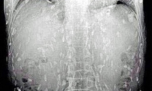 Hình ảnh sán dây tấn công khắp cơ thể người đàn ông.