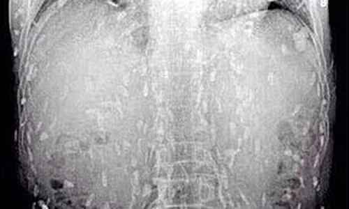 Hình ảnh sán dây tấn công khắp cơ thể người đàn ông.