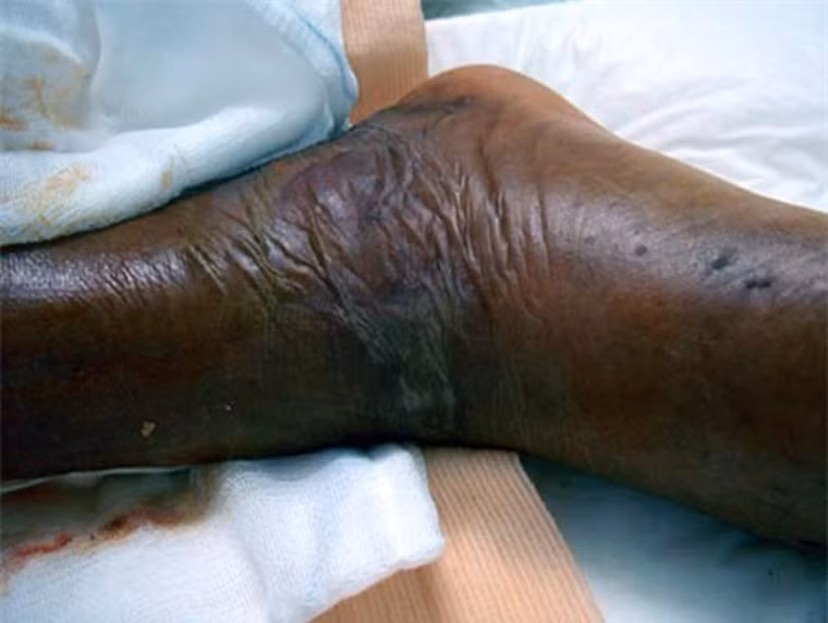 Nhìn chung, vi khuẩn “ăn thịt người” không bỏ qua bất kì bộ phận nào trên cơ thể song nguy hiểm nhất là bộ phận sinh dục. Tại đây, chúng gây ra viêm mô tế bào, làm viêm các tổ chức da, gây hoại tử, eczema.