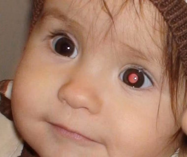  Xuất hiện vết cộm nhỏ, khối thịt dày. Nhiều người tỏ ra thờ ơ khi mắt bỗng xuất hiện vết cộm nhỏ hoặc khối thịt dày. Tuy nhiên, hiện tượng này lại có thể bắt nguồn từ một khối u ung thư.