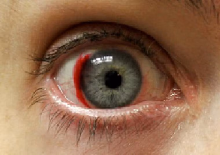  Xuất hiện vệt máu trong mắt. Hiện tượng chảy máu võng mạc là một trong những manh mối sớm nhất của tiểu đường tuýp 2. Khi lượng đường tích tụ trong máu quá cao, mạch máu bị chặn lại, sưng lên khiến những mạch máu nhỏ ở võng mạc bị vỡ ra, gây chảy máu. Tình trạng này nếu không được điều trị kịp thời dễ dẫn đến suy giảm thị lực, thậm chí có thể gây mù mắt.