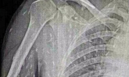 Chính sở thích thưởng thức sashimi tươi sống khiến anh lâm vào tình trạng này.