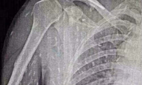 Chính sở thích thưởng thức sashimi tươi sống khiến anh lâm vào tình trạng này.