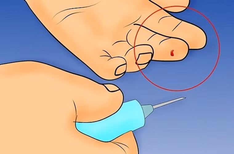 Lưu ý cần thiết nhất khi bị tấn công bởi vật nhọn, kim tiêm nghi “dính” HIV là tuyệt đối không được nặn máu ở khu vực này. Việc nắn bóp vết đâm không có tác dụng đẩy vi rút HIV ra khỏi cơ thể mà khiến vết thương dễ sưng tím, tạo cơ hội cho vi rút HIV thâm nhập dễ hơn.