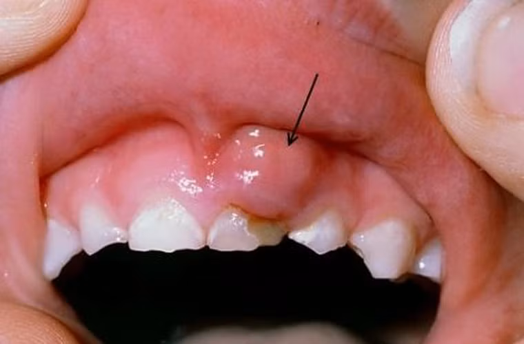 Ngoài ra, tế bào ung thư lưỡi còn gây nên tình trạng viêm nướu, khiến răng yếu đi và khó có thể ăn thực phẩm cứng. Tốt nhất, nếu răng bỗng trở nên lung lay mà không rõ nguyên nhân, bạn nên đi khám bác sĩ để phát hiện nguyên nhân vấn đề.