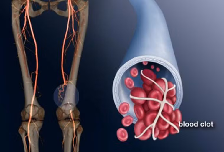 Thậm chí, “treo chân” còn làm tăng nguy cơ phát triển cục máu đông ở chân. Khiến chúng dễ di chuyển lên trên, gây tắc phổi dẫn đến tử vong. Điều đặc biệt, sự hình thành cục máu đông như vậy khá phổ biến ở phụ nữ mang thai. Vì vậy, hạn chế hoạt động thể chất thời gian này lợi ít rủi nhiều.