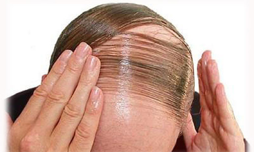 Nam giới 45 tuổi mắc chứng hói đầu có khả năng mắc ung thư tiền liệt tuyến cao hơn 40% so với người sở hữu mái tóc dày dặn. Ảnh minh họa.