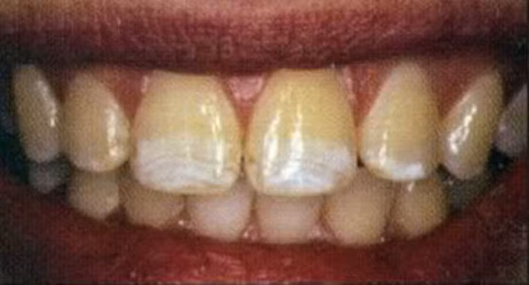 Răng đổi màu, đen xỉn. Hiện tượng răng trở nên đen xỉn có thể bắt nguồn từ sự mỏng đi của lớp men răng bên ngoài. Bên cạnh đó, sự thay đổi này còn do thói quen ăn trầu, thưởng chè đặc hay socola. Với những người nghiện thuốc, lượng nicotin trong chúng dễ dàng bám vào răng tạo thành một màu vàng xỉn, thâm đen; thậm chí là hôi miệng.