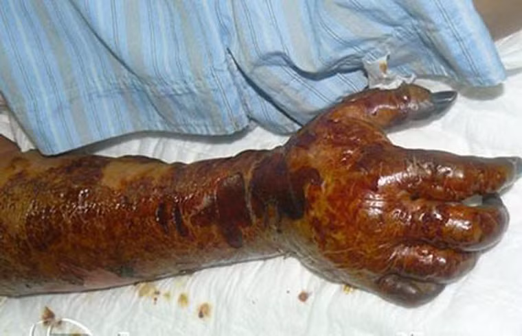 Khi nhiễm loại vi khuẩn này, trong vài giờ bệnh tiến triển, cơ thể xuất hiện các dấu hiệu như mô sưng, da đổi màu, phồng rộp kèm theo dịch nước, tiêu chảy và ói mửa. Trong giai đoạn đầu, các dấu hiệu viêm có thể không rõ ràng do khuẩn đang ở sâu trong mô. Tuy vậy khi lộ thiên, nó làm da đổi màu và chuyển sang hoại tử. Tỷ lệ tử vong ghi nhận cao tới 73% nếu không được chữa trị hay trợ giúp y tế kịp thời.